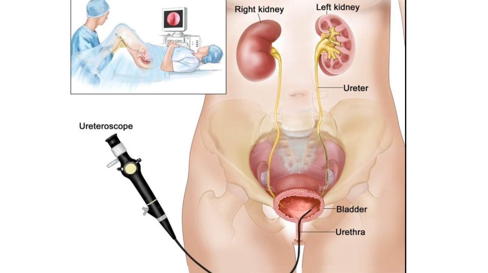 Best Kidney Stone Treatment in Chandigarh – No Cut Laser Surgery at Optimum Clinic Mohali